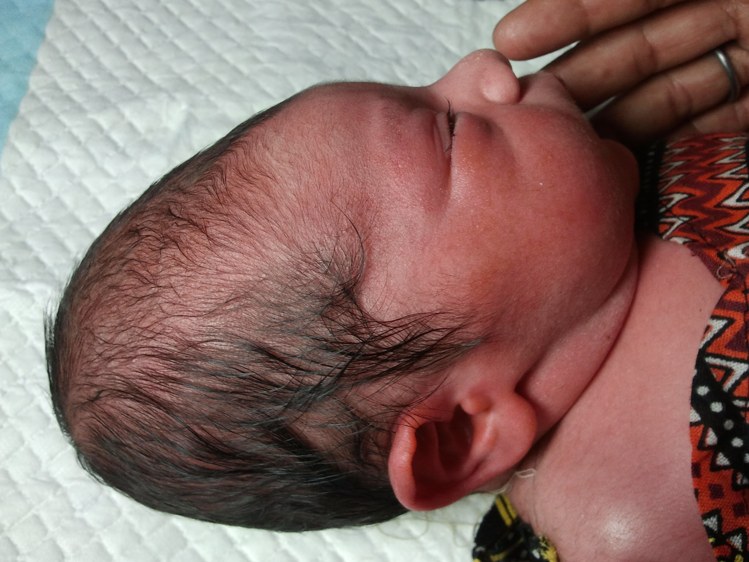 नवजात के सिर का आकार newborn head molding